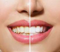 Teeth whitening, at home or in the dentist's Office?