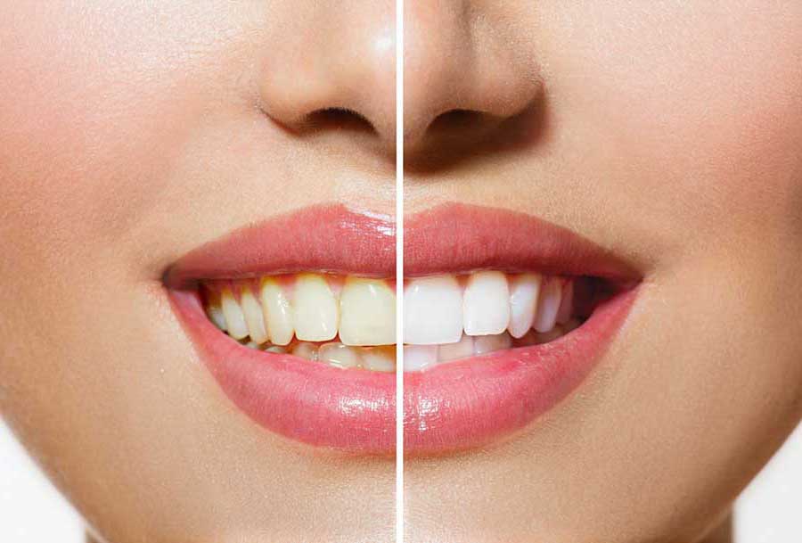 Evde veya dişçi ofisinde diş beyazlatma?