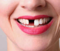 Best teeth whitening gel