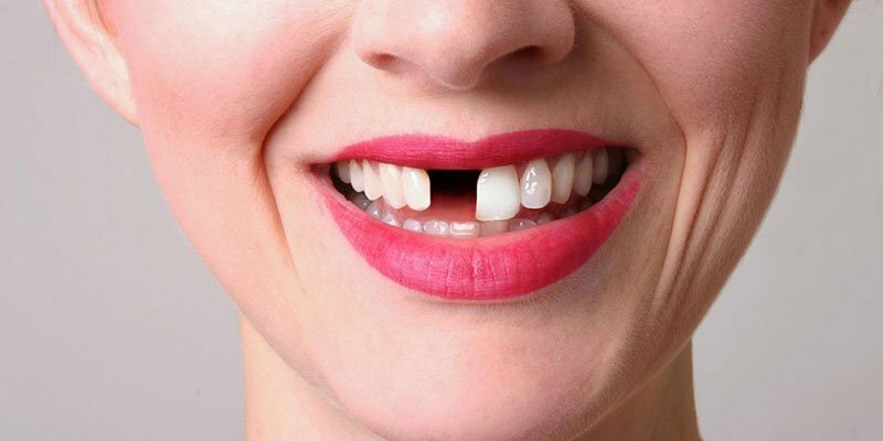 I migliori denti che sbiancano il gel