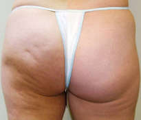 Cellulite and mesotherapy