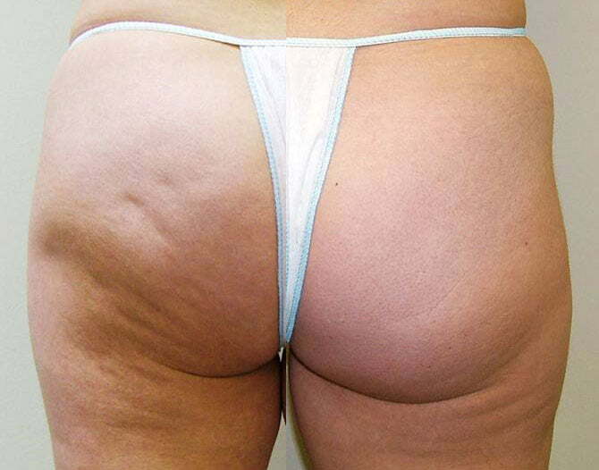 Cellulite en mesotherapie