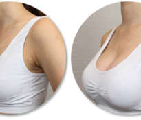 Natural improvement in the appearance of the breast