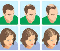 androgenetic-alopecia-in-women-and-men