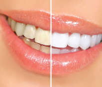 natural-white-teeth