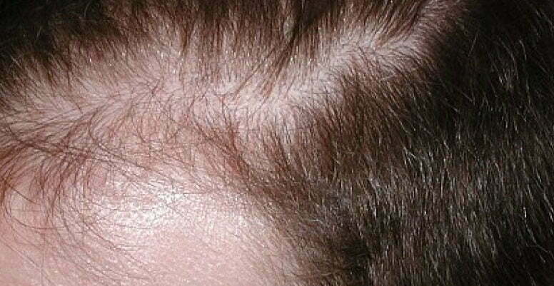 Obat alami untuk rambut rontok