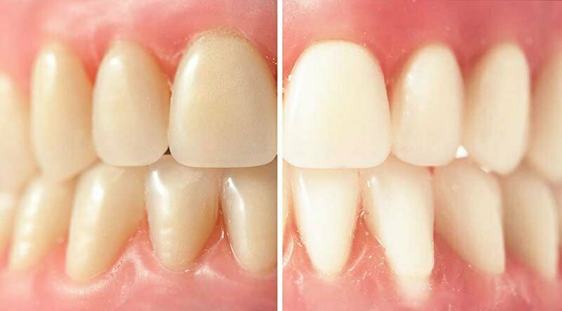 Основы отбеливания зубов