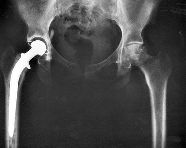 bol nakon injekcije u zglobu kuka prehrana u liječenju artroze koljena