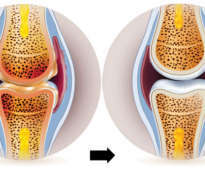 A new trend in the treatment of joint pain and stiffness