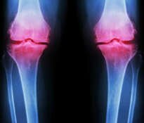 Inflammation of joints and the immune system