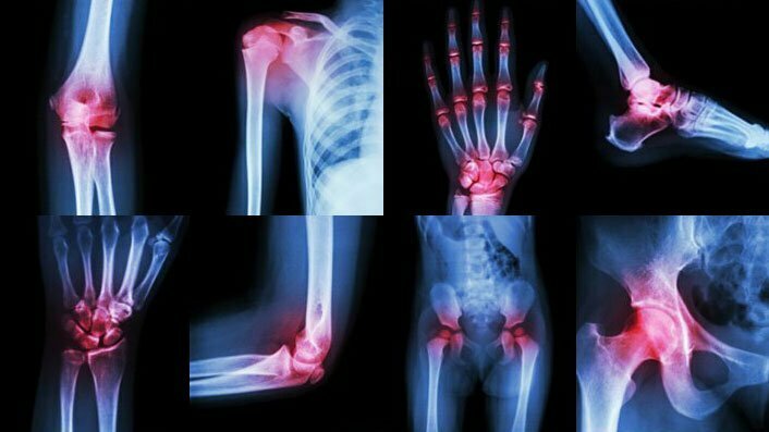 Hvordan understøtter behandlingen af ​​arthritis?