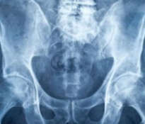 Strengthening the bones and preventing osteoporosis